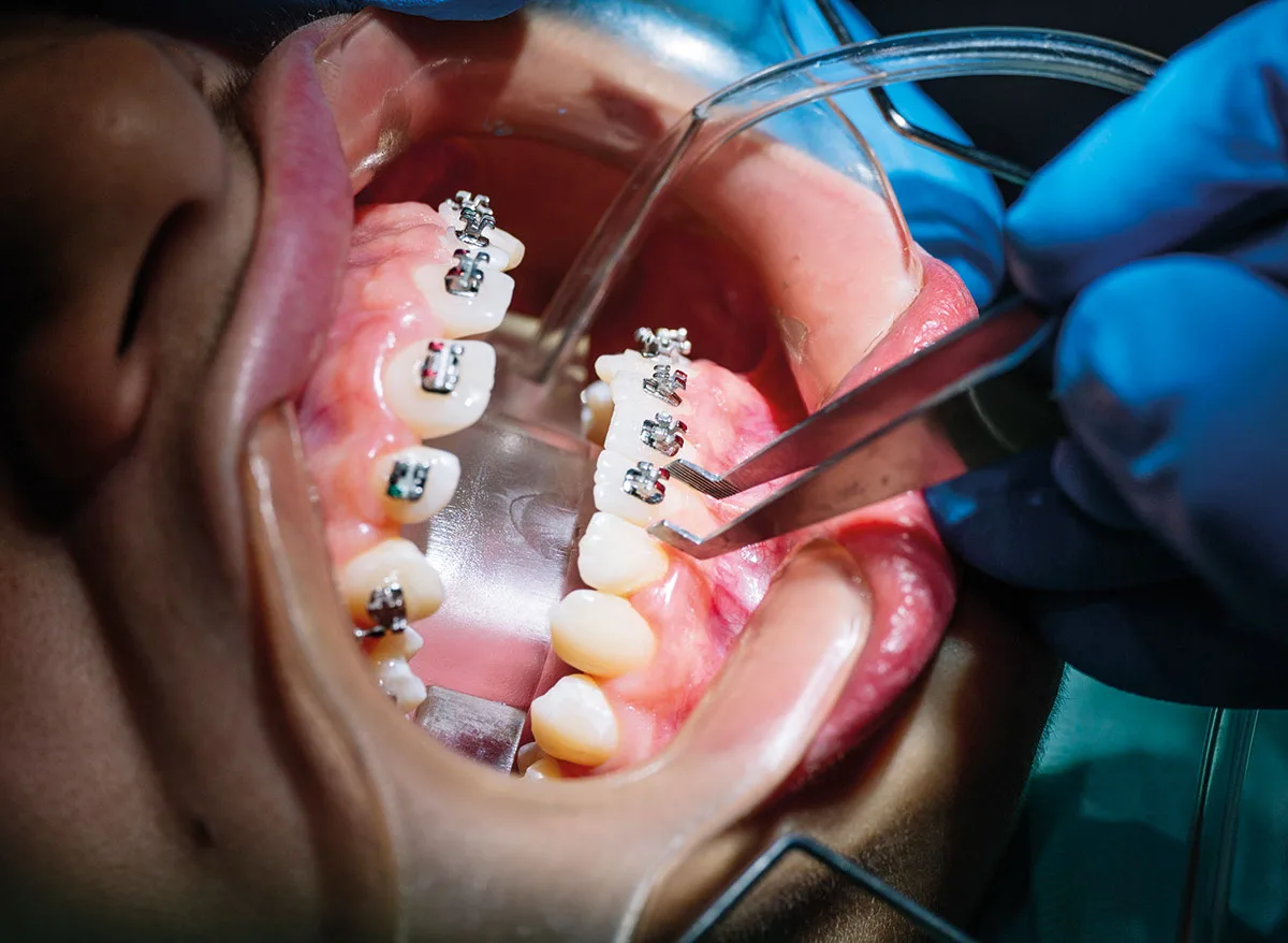 Ortodontik Tedavi Kimler İçin Uygundur?