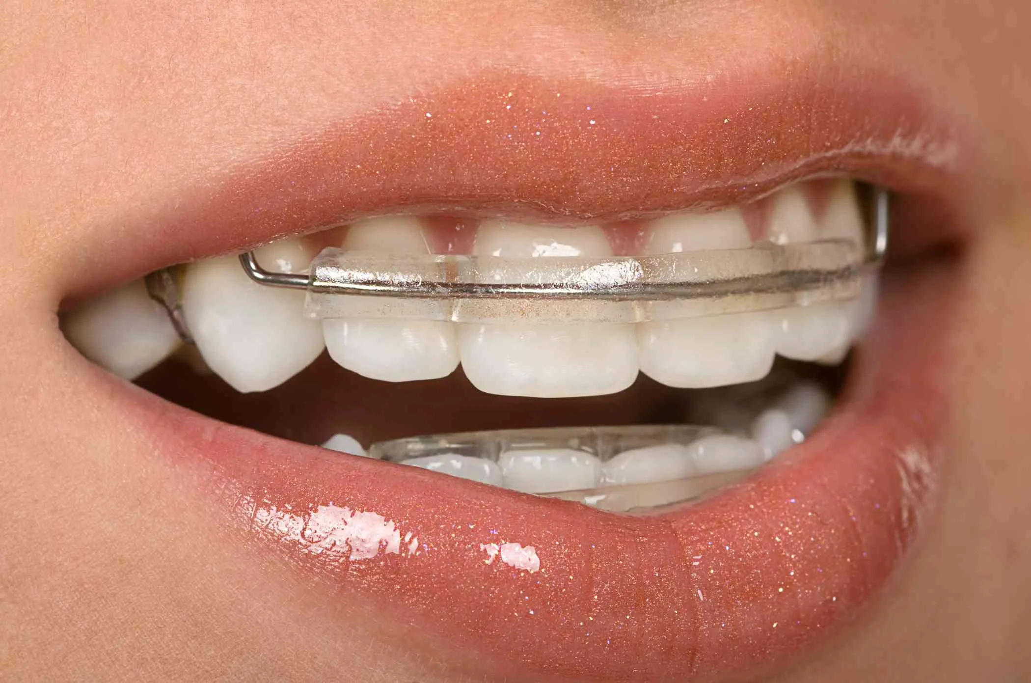 Retainer Kullanımı Neden Önemlidir?